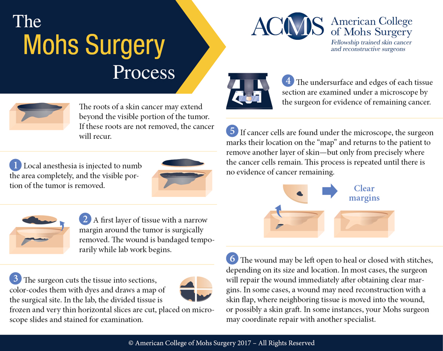 Mohs Surgery For Skin Cancer In Ocala Fl Carlyle Dermatology